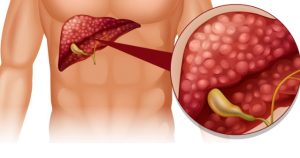 Pankreas Kanseri Belirtileri